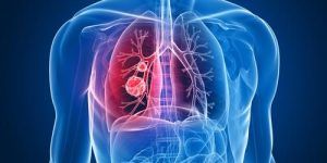 Asbestos Lung Cancer [Full Information]