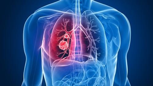 Asbestos Lung Cancer [Full Information]